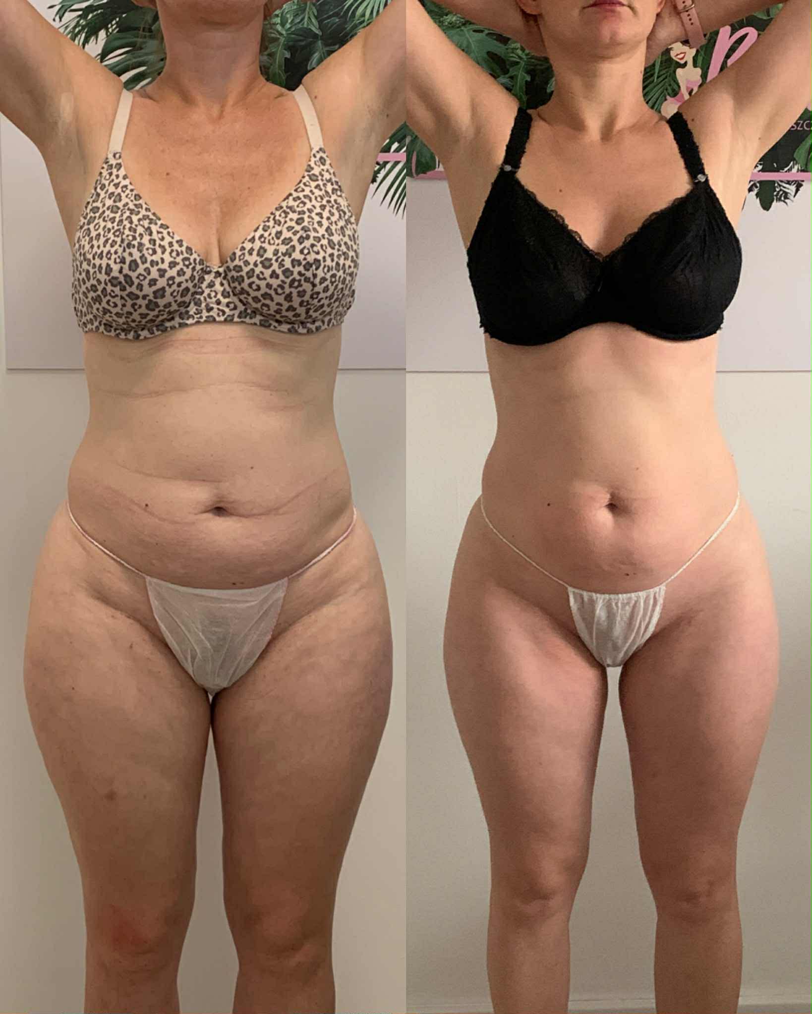 Efekt przed i po ujędrnianiu