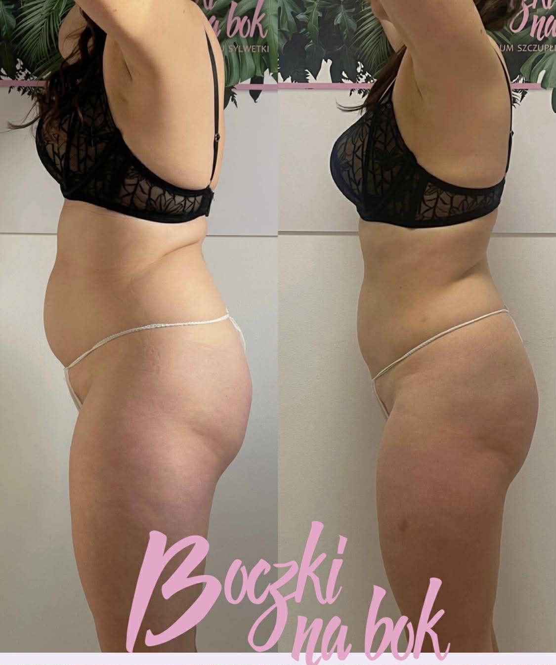 Efekt przed i po redukcji cellulitu