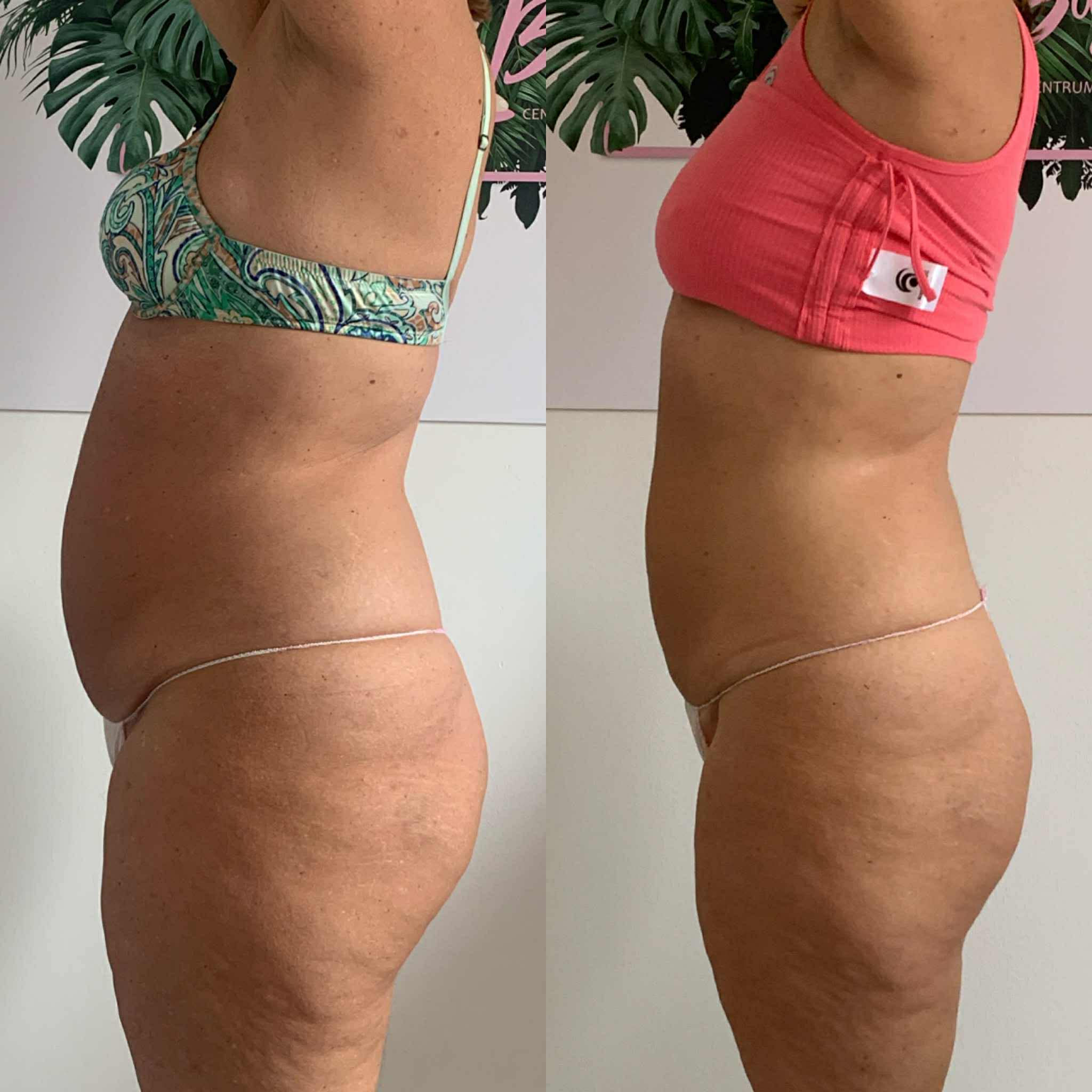 Efekt przed i po ujędrnianiu